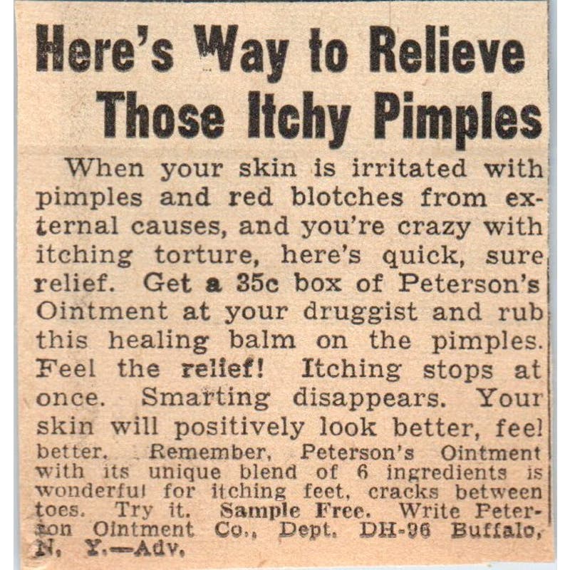 Peterson's Ointment Pimple Relief 1935 Minneapolis Journal Advertisement AE7-H2